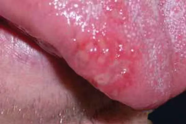 The Ultimate Guide to Natural Canker Sore Treatment Image