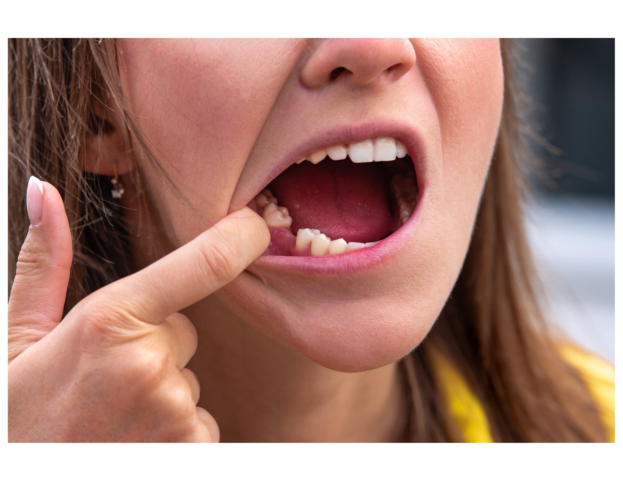 Natural and Effective Dry Socket Treatment Image