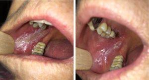Postsurgical discomfort and at-home recovery Image