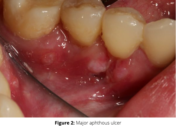 Canker sores: An old enemy facing new treatment Image