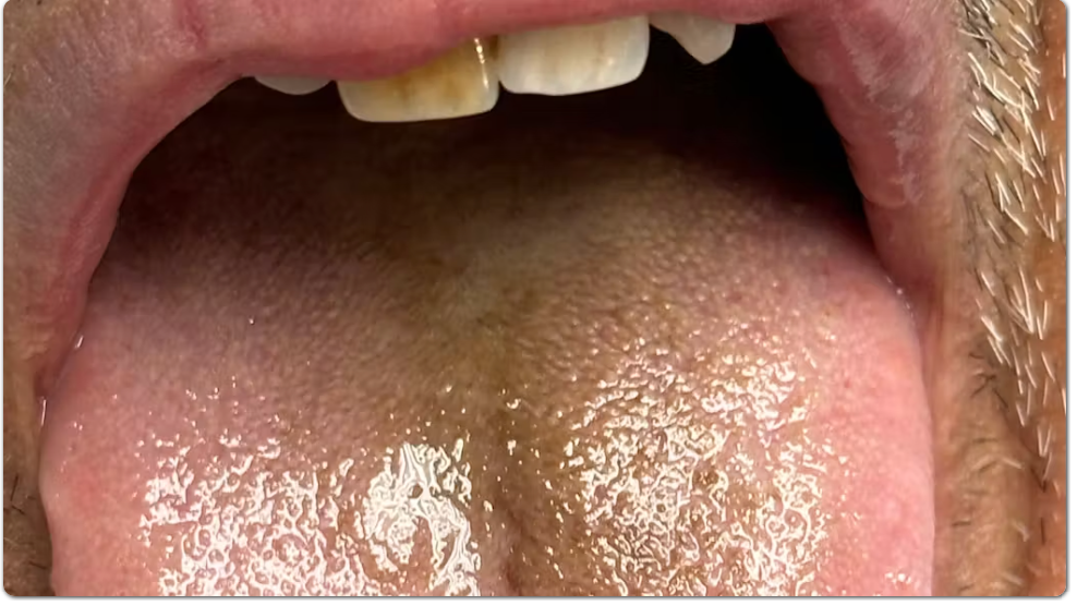 Black tongue: What is it, and how is it treated? by Dr. Scott Froum Image