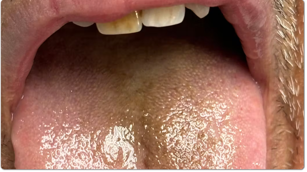 Black tongue: What is it, and how is it treated? by  Dr. Scott Froum Image