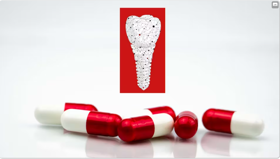 Antibiotics: Are they needed for dental implant placement?  by  Dr. Scott Froum Image