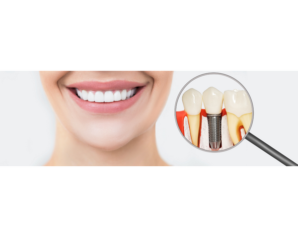 Healing After Dental Implant Surgery