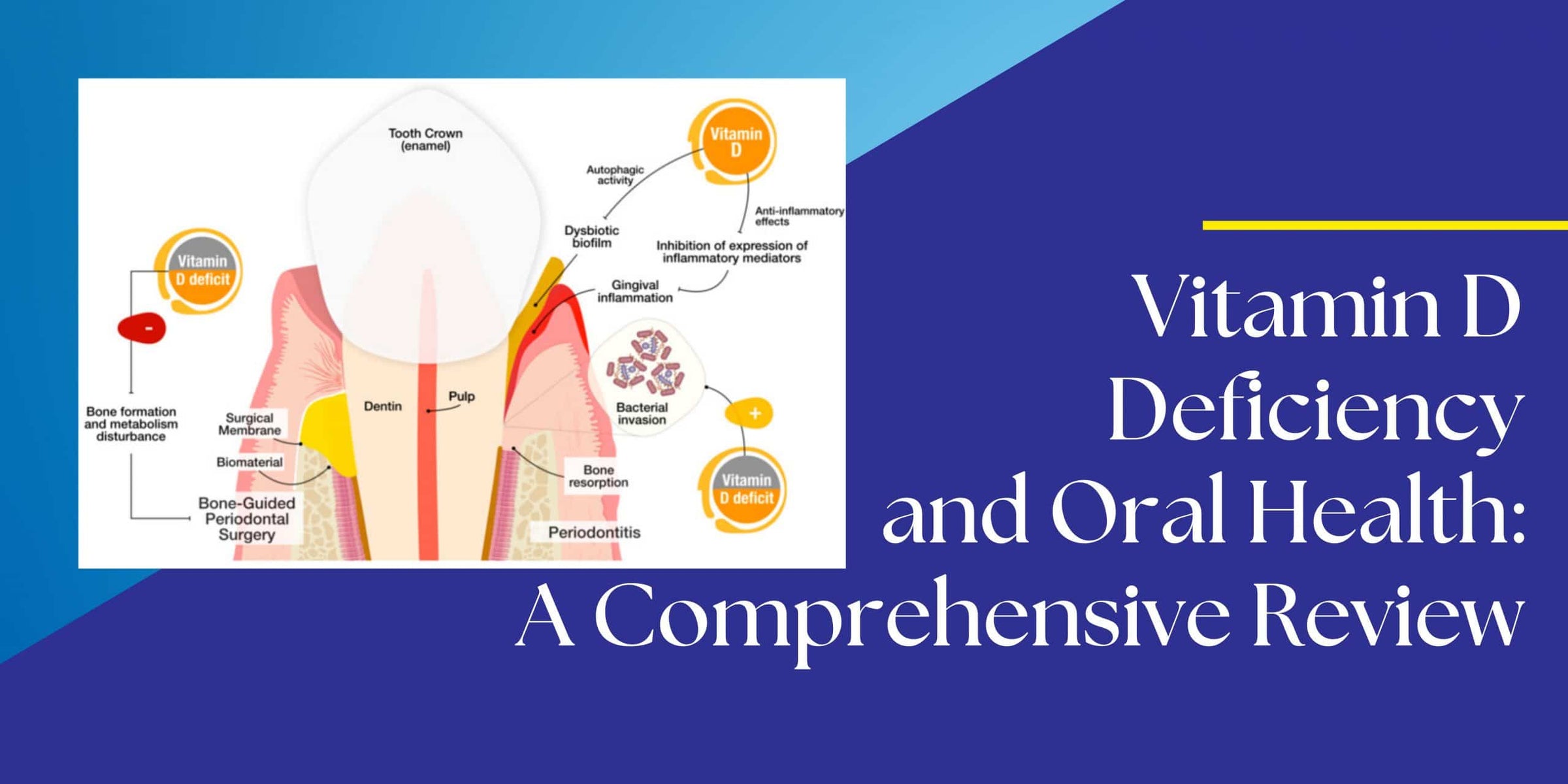 Vitamin D Deficiency and Oral Health: A Comprehensive Review Image