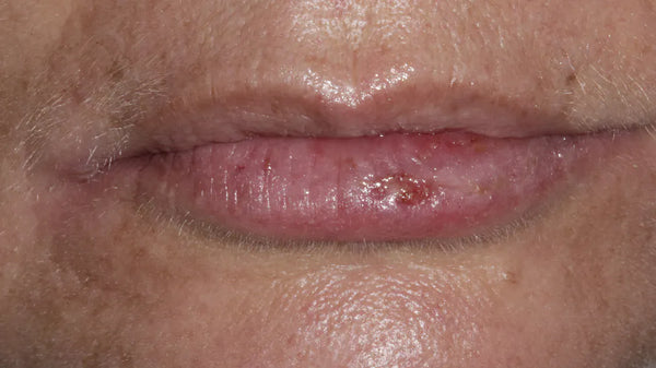 Laser treatment of cold sores